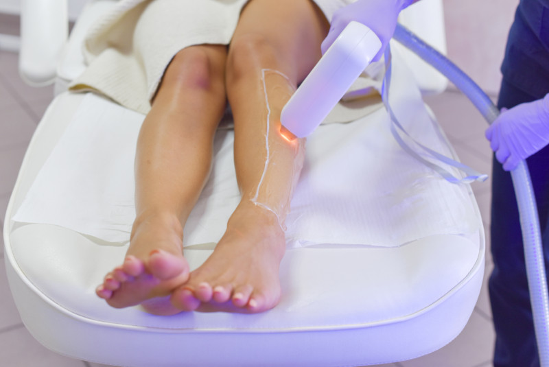 IPL alebo laser: Ktorá metóda epilácie je skutočne efektívna a trvalá?